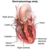 Tilt Test - AF-ABLATION